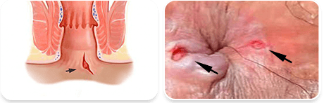 Chấn thương hậu môn
