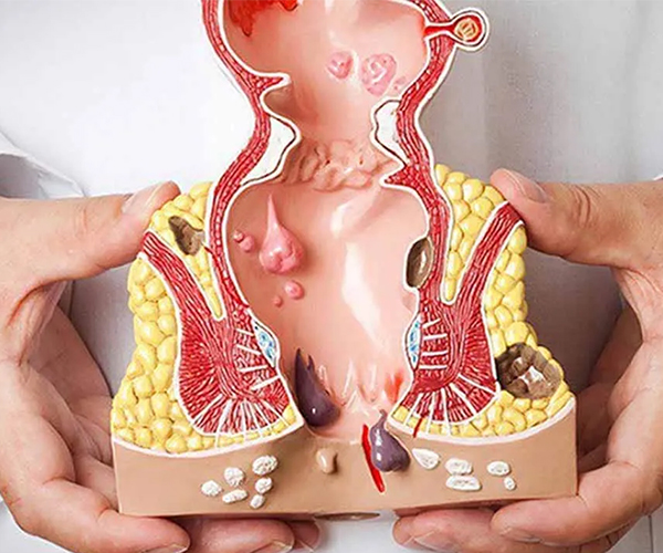 Đại tiện ra máu