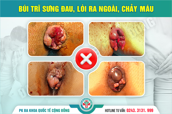 Cắt trĩ ngoại: Khi nào cần thực hiện và đâu là giải pháp điều trị an toàn, hiệu quả?