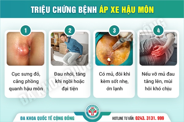 Triệu chứng áp xe hậu môn rất dễ gặp – Liệu có phải bạn đang bỏ qua?