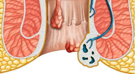 Trĩ hỗn hợp