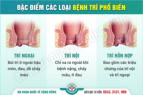 Bác sĩ hơn 40 năm kinh nghiệm chia sẻ cách chữa trĩ nội hiệu quả nhất