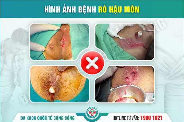 Những lưu ý để chữa rò hậu môn thu được hiệu quả tốt nhất