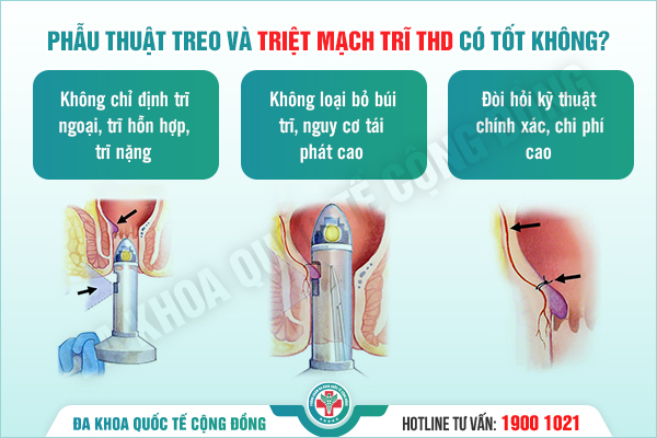 Cảnh báo: Những sai lầm phổ biến khi lựa chọn phương pháp THD điều trị trĩ