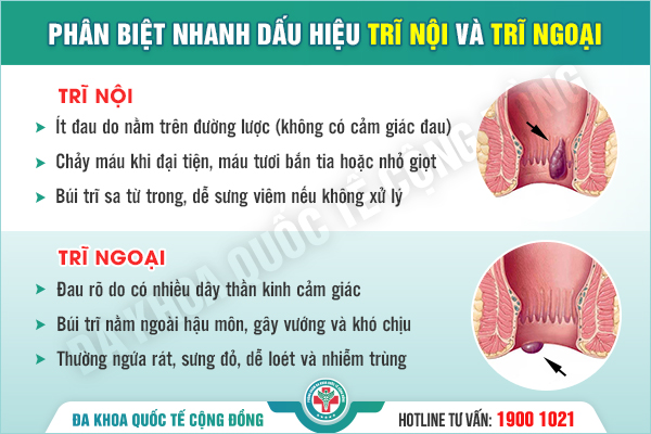 Nổi mụn thịt ở hậu môn, có phải là trĩ? Gợi ý phân biệt với các bệnh lý khác