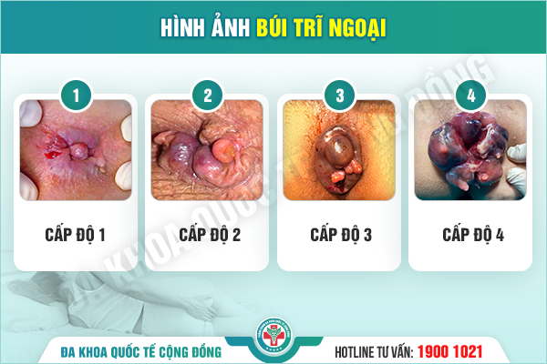 Cắt trĩ ngoại – Nếu chọn sai, bạn không chỉ “đau”, mà còn “tiếc cả đời”