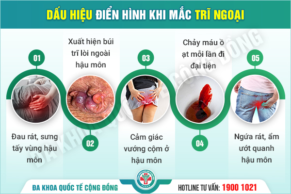 Trĩ ngoại – Đừng để đau đến kiệt sức mới đi khám!