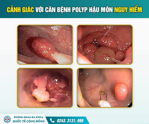 Chảy máu hậu môn do polyp: Dấu hiệu không còn lành tính!