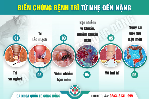 Trĩ ngoại có nguy hiểm không? Giải đáp chi tiết từ chuyên gia