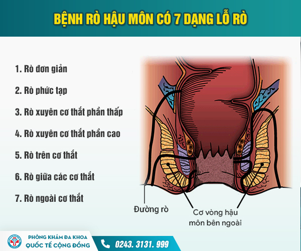 Chữa rò hậu môn không đắt như bạn vẫn nghĩ! Đọc ngay để tránh mất tiền oan!