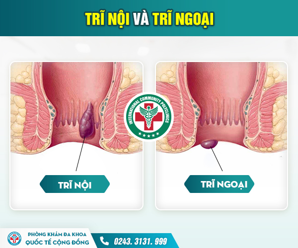 Đừng nhầm lẫn! Phân biệt ngay trĩ Nội và trĩ Ngoại trước khi quá muộn