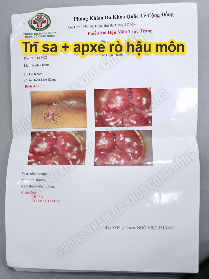 Hậu môn chảy mủ: Đừng vội nghĩ là trĩ – Có thể là rò hậu môn hoặc bệnh lý nguy hiểm khác