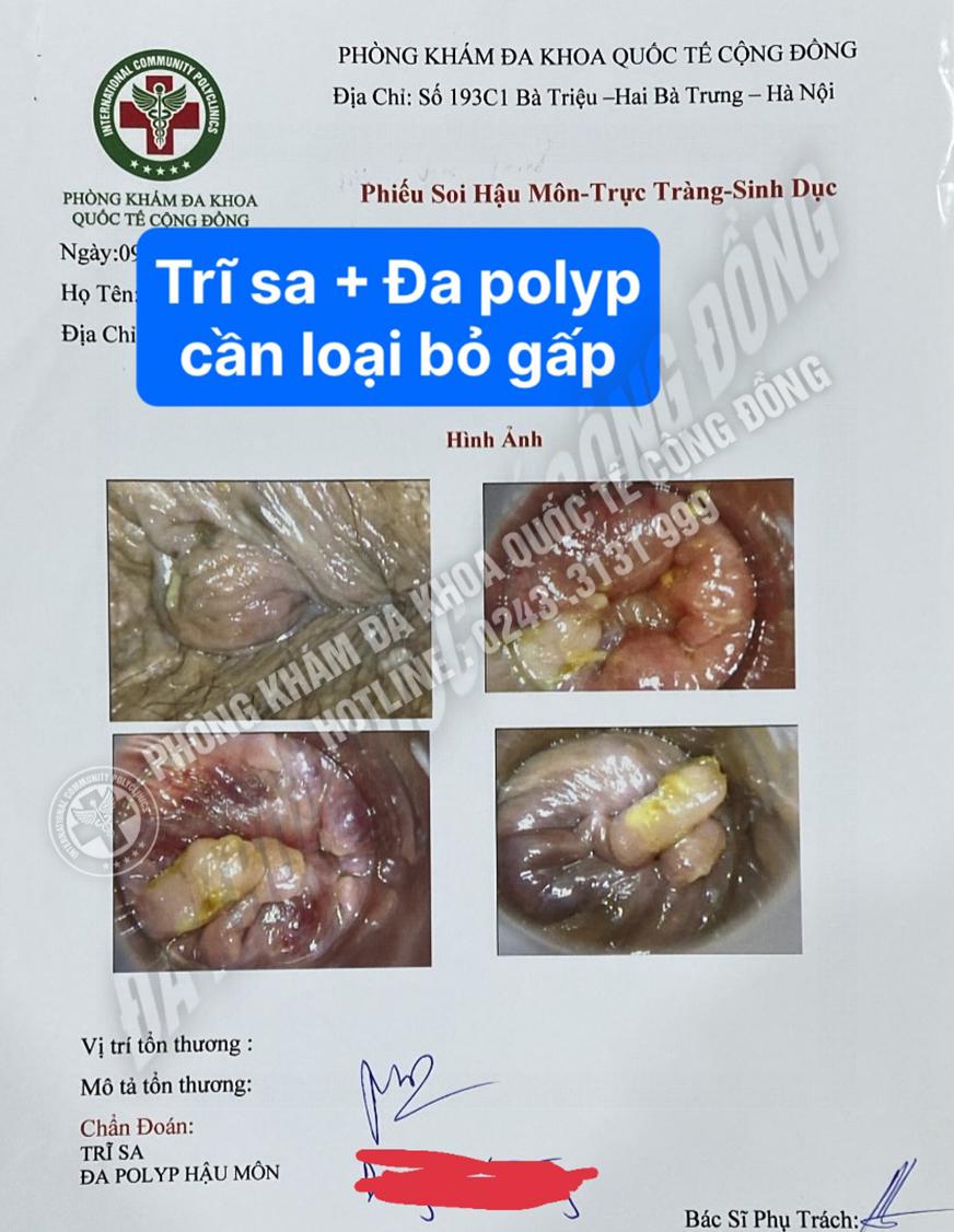 Chia sẻ trải nghiệm thực tế: Khi búi trĩ lòi ra ngoài – đừng chủ quan