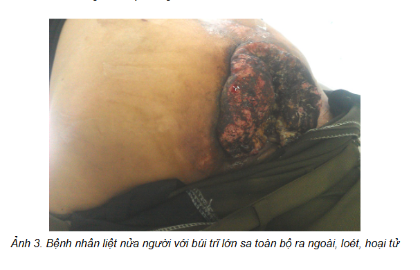 Cách chữa trĩ nội nhẹ: Đừng để “nhẹ” khiến bạn trả giá bằng biến chứng nặng