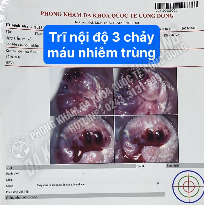 Nguyên nhân gây đại tiện ra máu: Khi nào cần đi khám ngay?