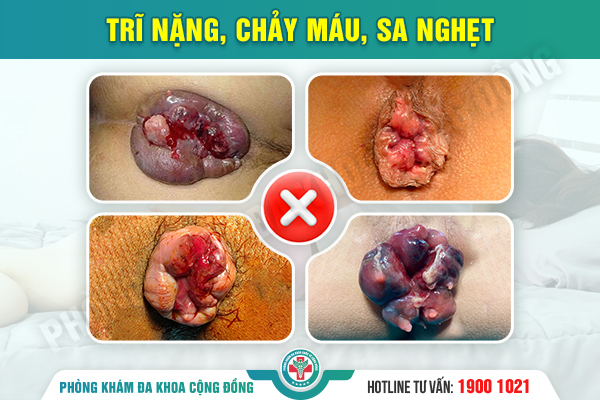 Bệnh trĩ nội điều trị như thế nào cho đúng, hạn chế tái phát?